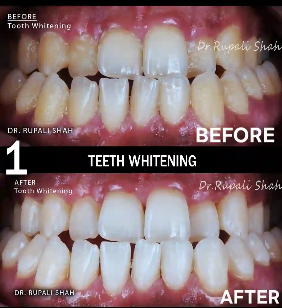 Implant-Supported Overdenture by the best dentist for dental implants in Mumbai 